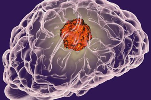 Phát triển phân tử mồi nhử giúp hạn chế di căn ung thư não, vú