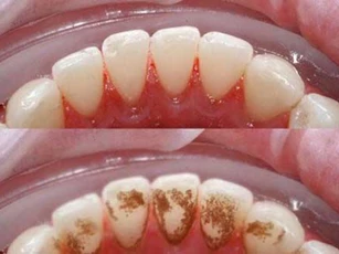 Cao răng dày đến mấy cũng tự bật ra từng mảng, hôi miệng cỡ nào cũng hết chỉ với 1 ngàn đồng