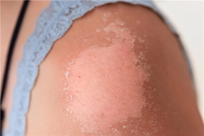 Vết cháy nắng có thể tồn tại bao lâu trên da và biện pháp giúp da lành nhanh hơn - Ảnh 2.