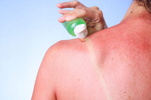 Vết cháy nắng có thể tồn tại trên da bao lâu và biện pháp làm dịu, phục hồi da nhanh hơn