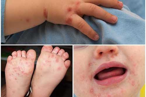 Bác sĩ chỉ dấu hiệu trẻ bị tay chân miệng, nhiều bố mẹ chủ quan bỏ qua