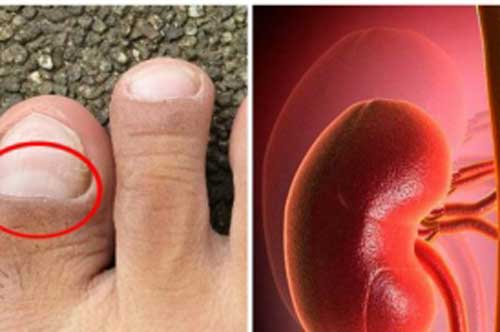 Thấy bàn chân có "điềm báo' này, hãy cảnh giác vì thận đang gửi lời báo động nhiễm độc nặng