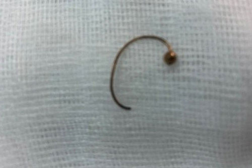 Tìm thấy hoa tai thất lạc trong... thực quản