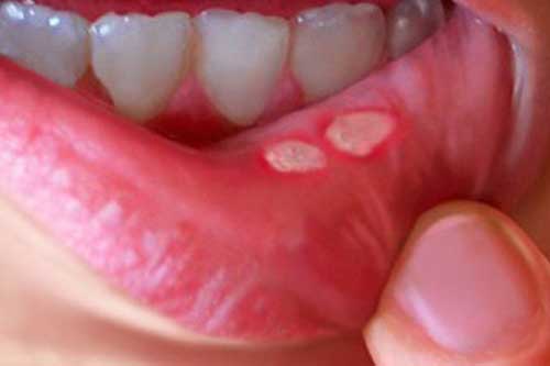 Bị nhiệt miệng chỉ cần ăn 2 loại rau này là khỏi