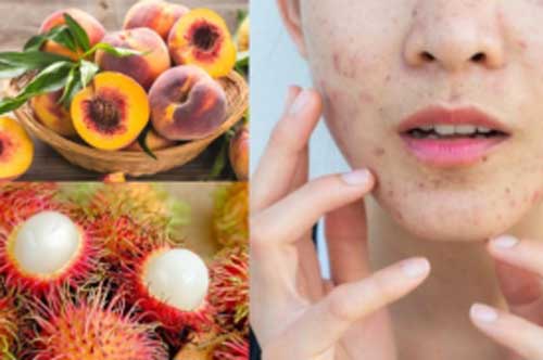 Ăn nhiều trái cây cực tốt cho cơ thể nhưng có 6 loại dễ gây mụn, chị em cần chú ý