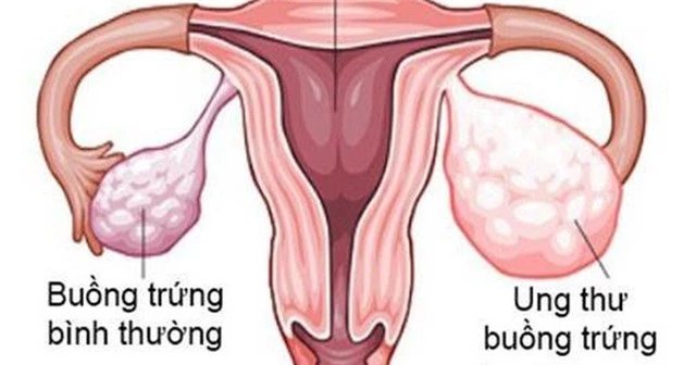 Bé 11 tuổi mắc ung thư buồng trứng nhưng bố mẹ nhầm là béo bụng, chuyên gia chỉ rõ nếu có dấu hiệu này cần đi khám sớm - Ảnh 3.