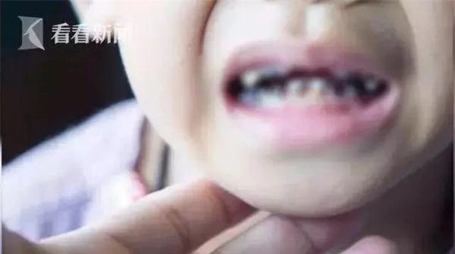 Uống loại nước này mỗi ngày khiến hàm răng của cậu bé 2 tuổi bị hư hại nghiêm trọng - 1