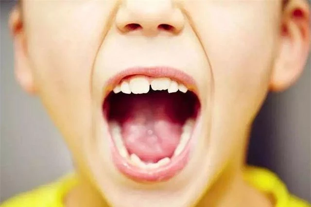 Uống loại nước này mỗi ngày khiến hàm răng của cậu bé 2 tuổi bị hư hại nghiêm trọng - 4