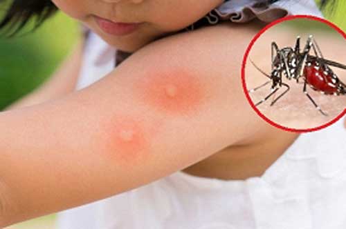 Mẹo trị muỗi đốt cho trẻ cực hiệu quả, mẹ bỉm sữa nào cũng cần biết