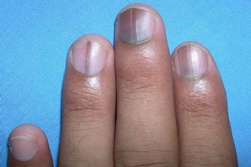 Nếu bàn tay có dấu hiệu này thì hãy đi khám ngay kẻo ung thư phổi, gan 'ghé thăm' 