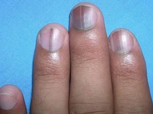 Nếu bàn tay có dấu hiệu này thì hãy đi khám ngay kẻo ung thư phổi, gan 'ghé thăm'