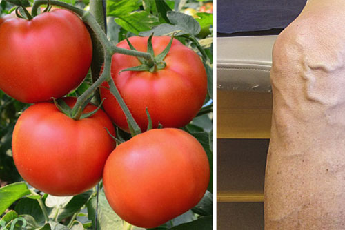 Bất ngờ với loại quả làm 'biến mất' chỗ suy giãn tĩnh mạch có ngay trong nhà bạn