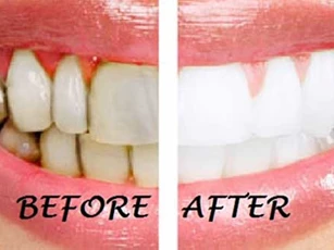 Nhai thứ này mỗi sáng, răng trắng bóng như sứ và hết hẳn hôi miệng sau vài ngày