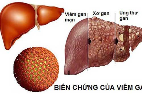 5 kiểu người dễ bị ung thư gan nhất, xem bạn có trong số đó không