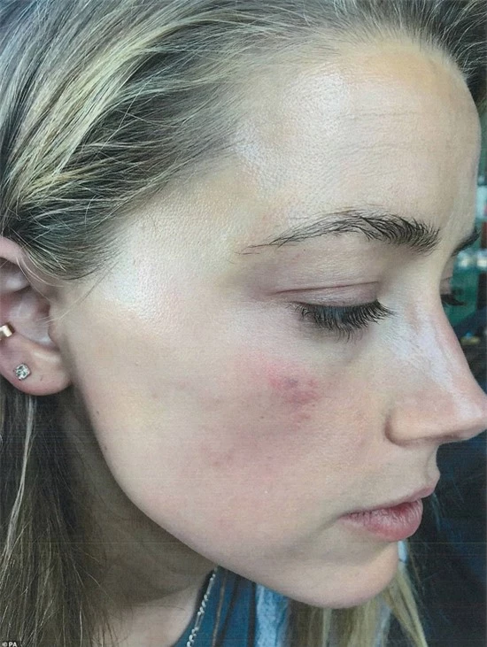 Amber Heard cung cấp bức ảnh mặt bị thương trong một lần Johnny Depp tấn công cô trên giường.