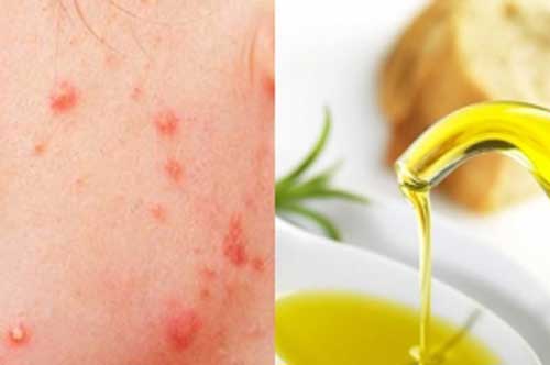 Diệt sạch mụn và vết thâm trong vòng 3 đêm với 1 giọt 'thần dược' này