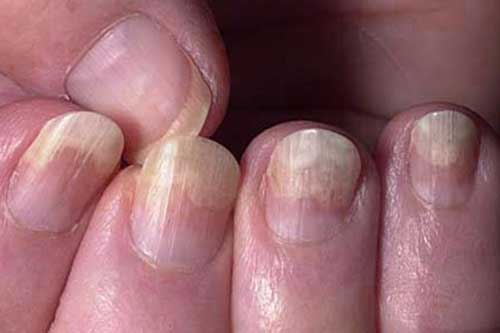 Nếu thấy móng tay có biểu hiện này cảnh báo cơ thể đang gặp bệnh, hãy đi kiểm tra sức khỏe ngay