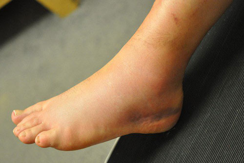 Nếu phát hiện chân có dấu hiệu này thì hãy đi khám sức khỏe gấp kẻo hối không kịp