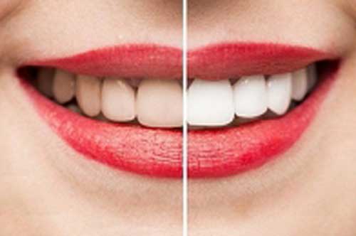 Những cách giúp làm trắng vết ố vàng trên răng hiệu quả ngay tại nhà