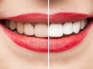 Những cách giúp làm trắng vết ố vàng trên răng hiệu quả ngay tại nhà