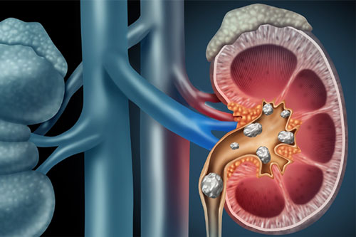 Chẳng cần thuốc thang gì, chỉ cần làm theo những cách này thì sỏi thận chẳng bao giờ 'dám ghé thăm' bạn