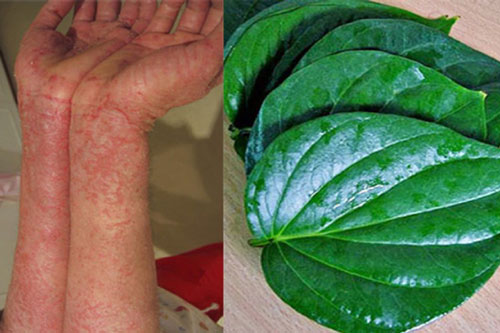 Cách đơn giản chữa viêm da cơ địa bằng lá trầu không mang lại hiệu quả bất ngờ