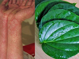 Cách đơn giản chữa viêm da cơ địa bằng lá trầu không mang lại hiệu quả bất ngờ