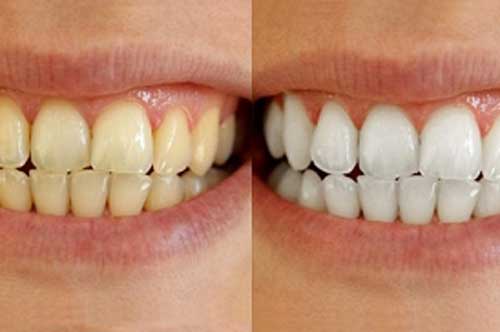 3 cách siêu đơn giản làm trắng răng hiệu quả ngay tại nhà