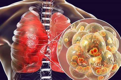 Khi ngủ thấy 4 dấu hiệu này, hãy nhanh chân đi khám ngay vì ung thư phổi đang "gõ cửa"