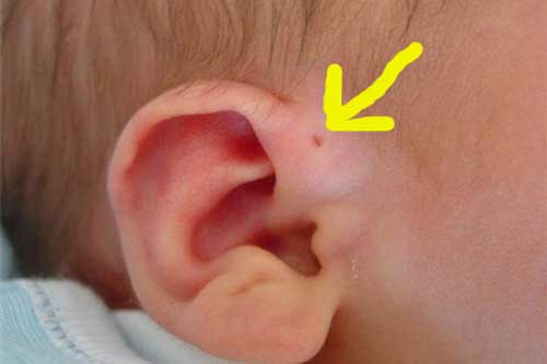 Thấy lỗ nhỏ ở vành tai kiểu này, đến gặp bác sĩ ngay vì căn bệnh nguy hiểm đang đứng ngay bên cạnh