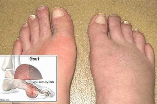 Dấu hiệu của bệnh gout