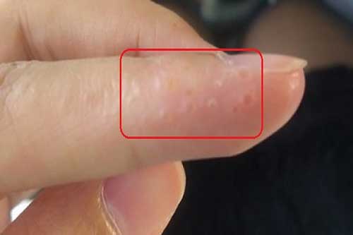 Khi thấy tay có mụn nước thế này nhớ đi khám ngay lập tức