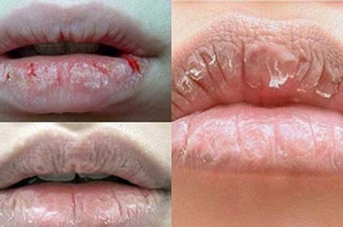 Thấy môi chuyển sang màu này mặc dù không tô son, hãy chủ động đi khám ngay đề phòng căn bệnh nguy hiểm