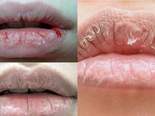 Thấy môi chuyển sang màu này mặc dù không tô son, hãy chủ động đi khám ngay đề phòng căn bệnh nguy hiểm