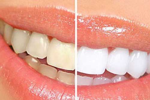 Những ai vừa tẩy trắng răng xong thì hãy dành 2 phút đọc qua bài này