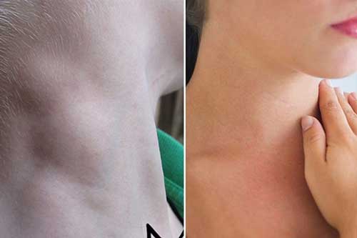 Thấy dấu hiệu lạ này xuất hiện ở cổ, hãy đến viện kiểm tra thật kĩ vì ung thư có thể đang "gõ cửa"