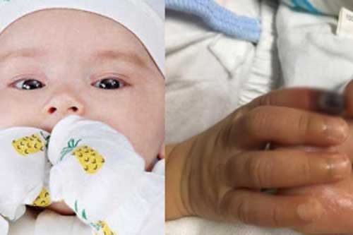 Bé sơ sinh có nguy cơ hoại tử đốt ngón tay do mẹ đeo bao tay cho con cả ngày không tháo