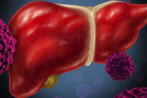 Đừng coi thường 6 dấu hiệu này vì đó là lời cảnh báo ung thư gan đang "gõ cửa"