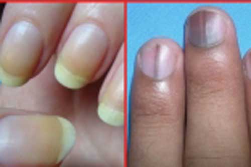 Thấy móng tay xuất hiện dấu hiệu này, cảnh báo căn bệnh nguy hiểm đang "đứng chờ" trước cửa