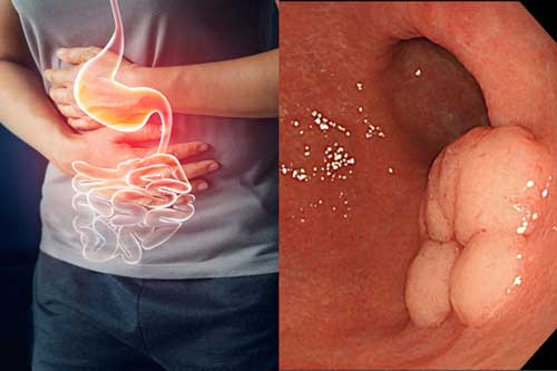 Những lưu ý cần biết để bảo vệ dạ dày của chính bạn và gia đình