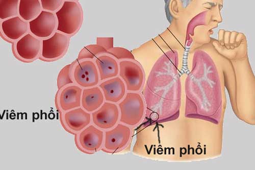 Gặp 6 dấu hiệu này hãy nghĩ ngay tới phổi đang hư hỏng nặng, hãy nhanh chân đi gặp bác sĩ ngay còn kịp