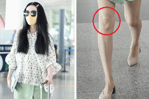 Phạm Băng Băng bị soi bàn chân gân guốc, đầu gối có sẹo khi diện chân váy ngắn