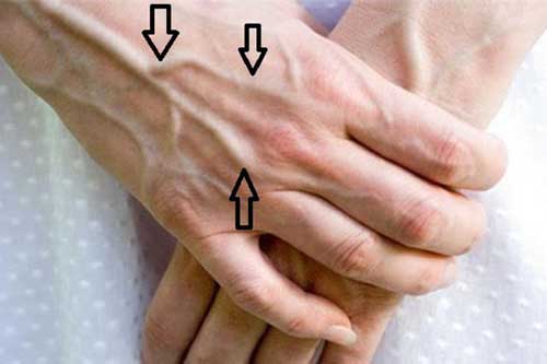 Gân xanh nổi lên chằng chịt ở những chỗ này: Hãy cẩn thận vì căn bệnh nguy hiểm đang "đứng ngay trước mặt"