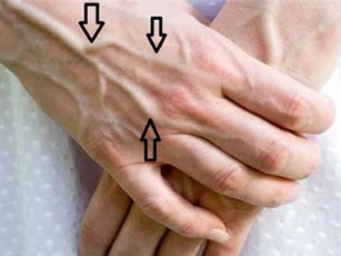 Gân xanh nổi lên chằng chịt ở những chỗ này: Hãy cẩn thận vì căn bệnh nguy hiểm đang "đứng ngay trước mặt"