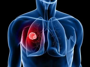 Ho sù sụ quá một tuần không khỏi: Hãy gặp bác sĩ ngay vì có thể bạn đã mắc căn bệnh nguy hiểm này