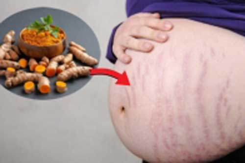 Cách trị rạn da bằng nghệ vừa rẻ lại hiệu quả bất ngờ, mẹ bầu nên thử ngay