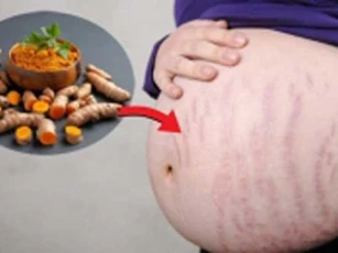 Cách trị rạn da bằng nghệ vừa rẻ lại hiệu quả bất ngờ, mẹ bầu nên thử ngay