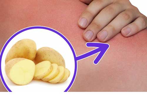 Lỡ bị bỏng, hãy cắt ngay một khoanh khoai tây đắp lên sẽ xảy ra điều kỳ diệu