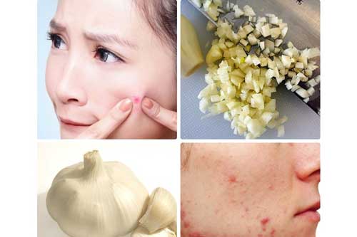 Không chỉ để nấu ăn, tỏi còn có 4 công dụng làm đẹp tuyệt vời sau