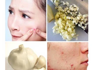Không chỉ để nấu ăn, tỏi còn có 4 công dụng làm đẹp tuyệt vời sau